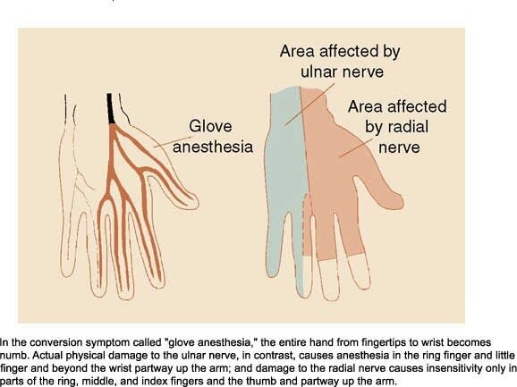 A medical diagram of 'glove anesthesia' contrasting numbness of the whole hand with the areas actually served by the ulnar and radial nerves.