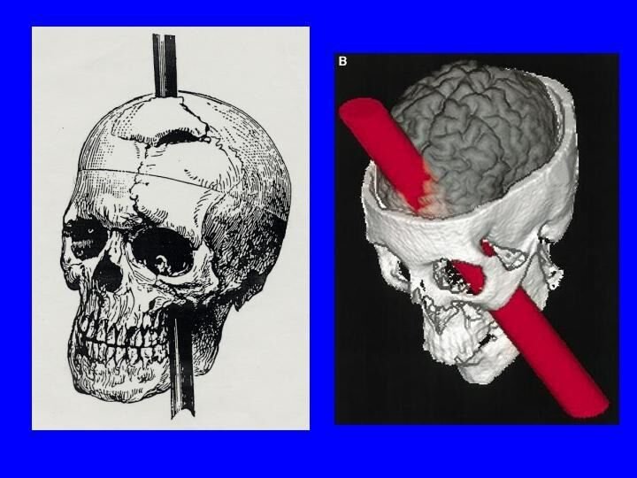 Two views of Gage's skull with the iron rod's path: a line engraving on the left and a colored 3-D CT reconstruction on the right.