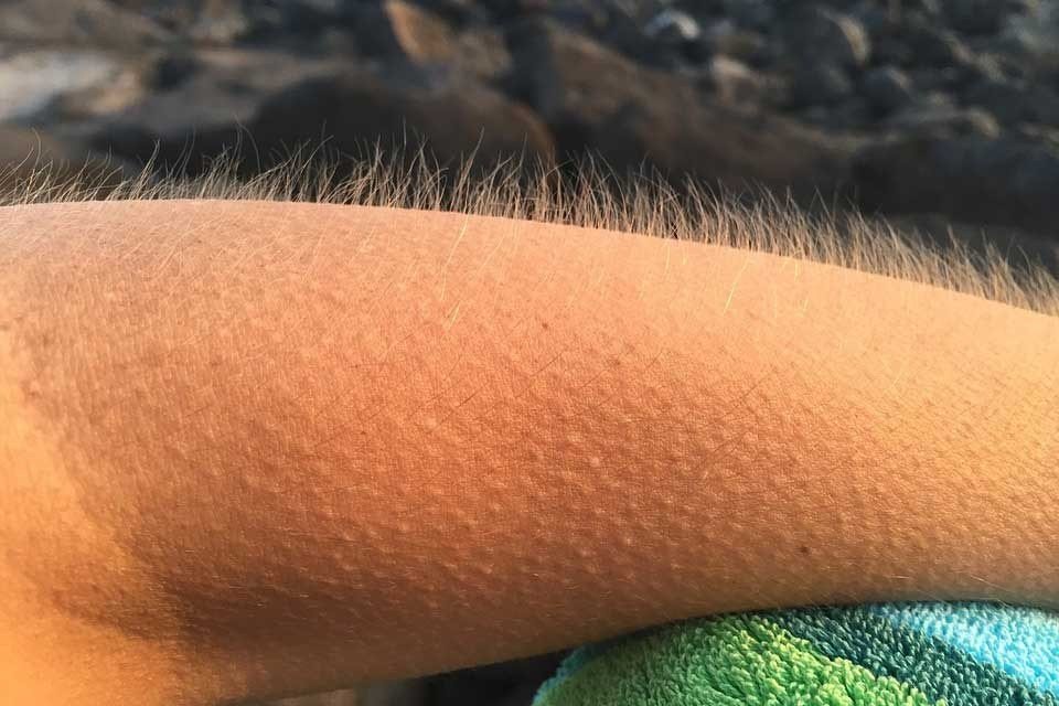 Close-up of a human forearm with body hair standing on end.